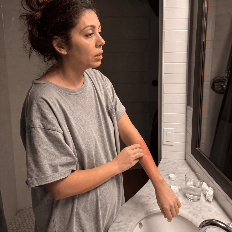 Woman lying awake at night with a skin flare-up
